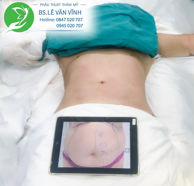Hút mỡ bụng an toàn với bác sĩ giỏi - 3