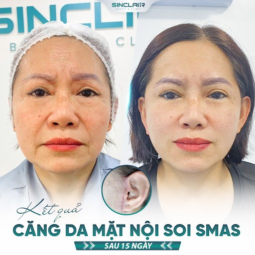 Sinclair Clinic - tiên phong căng da nội soi SMAS an toàn, uy tín, chuyên nghiệp - 2