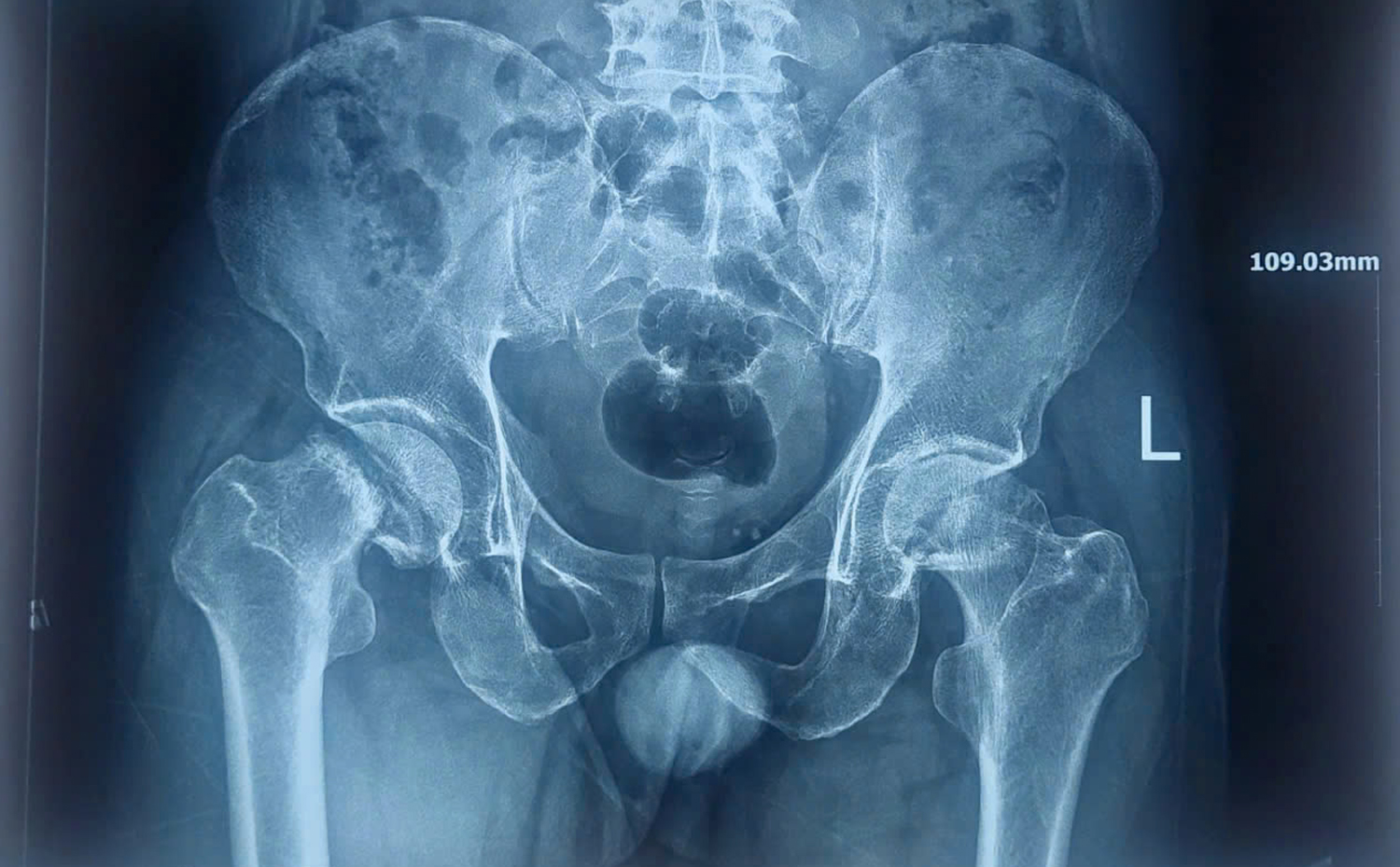 Bệnh viện ĐKTW Cần Thơ thay 2 khớp háng cùng lúc bằng đường mổ ít xâm lấn - 1