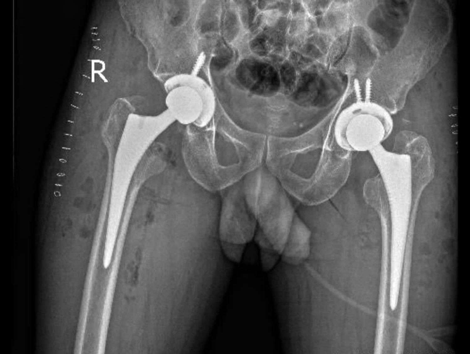 Bệnh viện ĐKTW Cần Thơ thay 2 khớp háng cùng lúc bằng đường mổ ít xâm lấn - 2