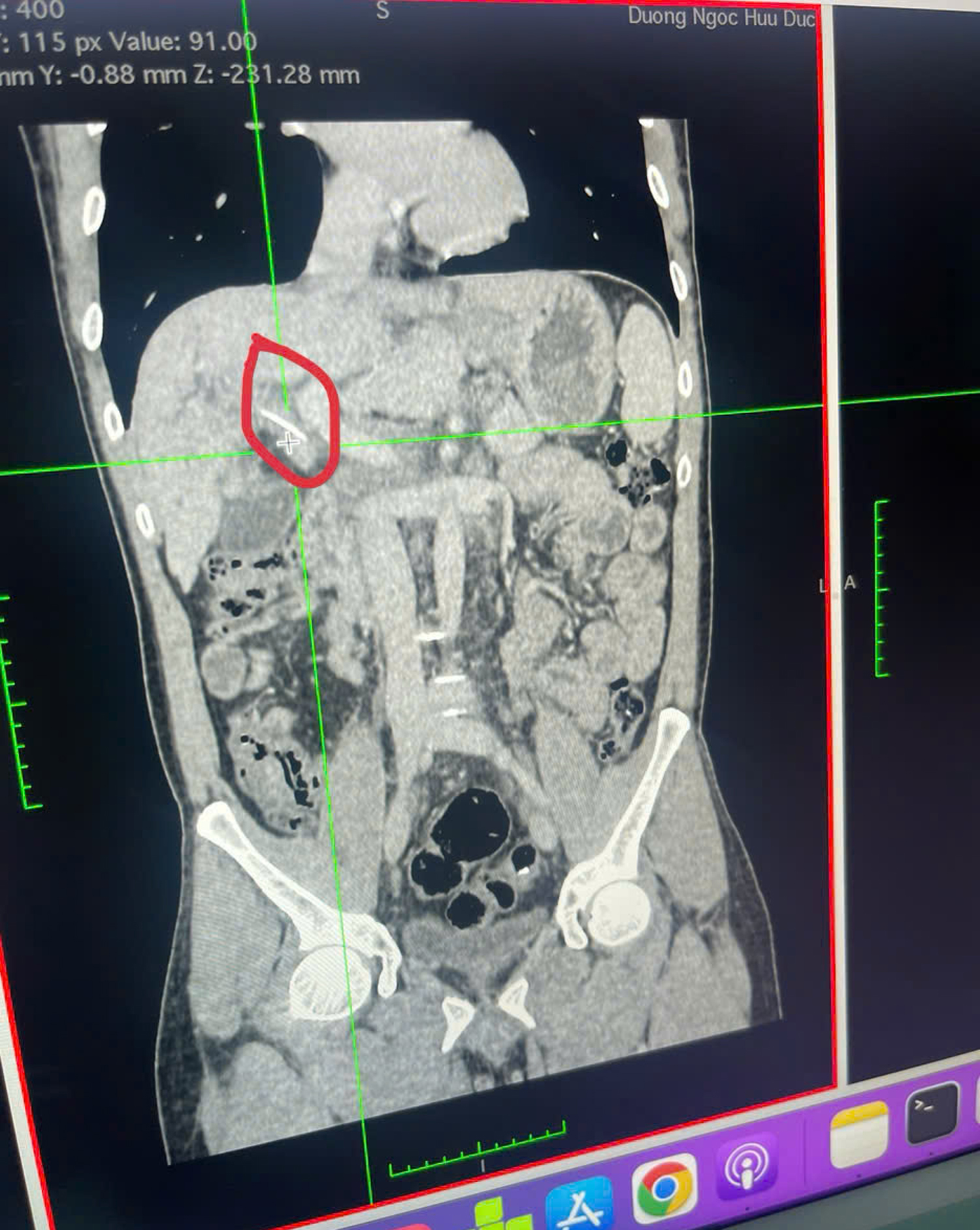 Bác sĩ lấy xương cá 3 cm xuyên vào đường mật người đàn ông ở Cần Thơ - 1