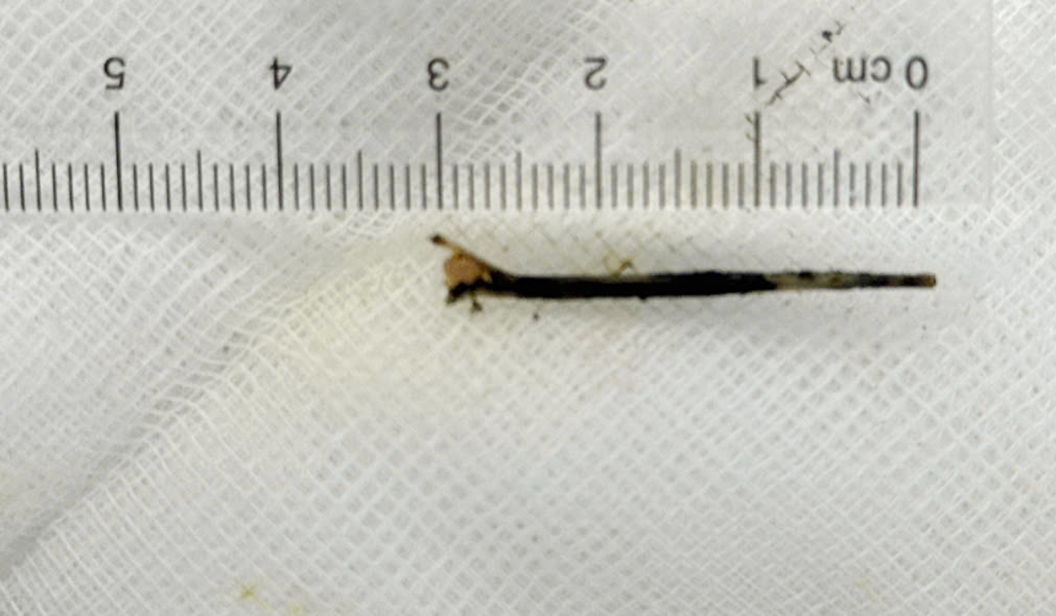 Bác sĩ lấy xương cá 3 cm xuyên vào đường mật người đàn ông ở Cần Thơ - 2