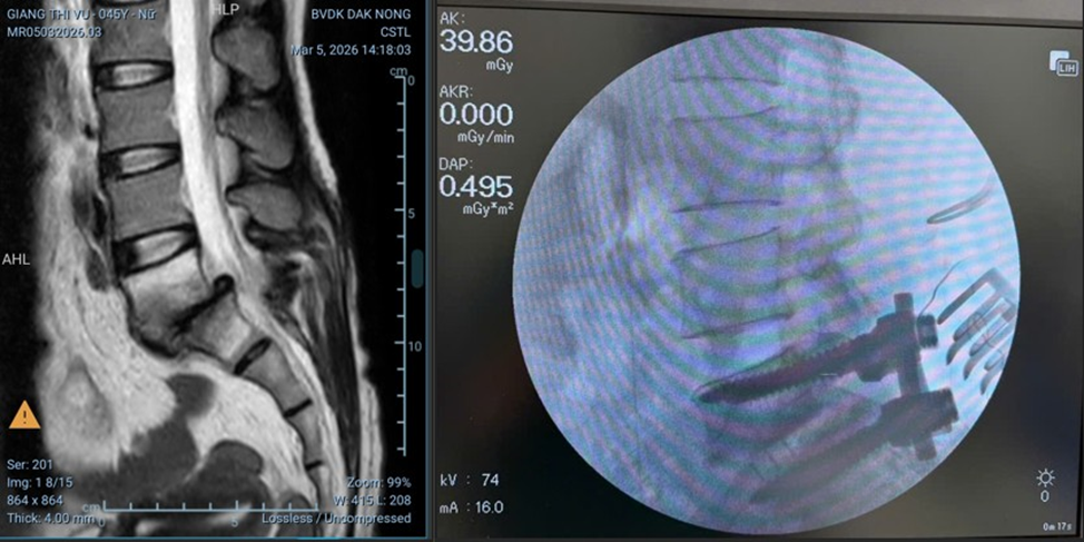 Bệnh viện ở Lâm Đồng phẫu thuật thành công 2 ca thoát vị đĩa đệm cột sống đầu tiên - 2