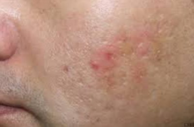 KỸ THUẬT PRP - LÀM ĐẸP BẰNG …MÁU - 3