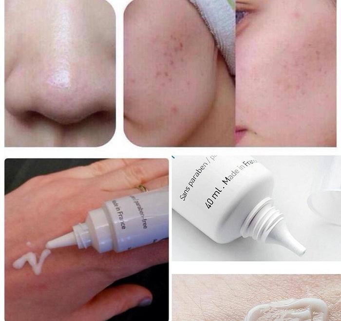 Review tất tần tật về kem giảm mụn La Roche Posay - 2