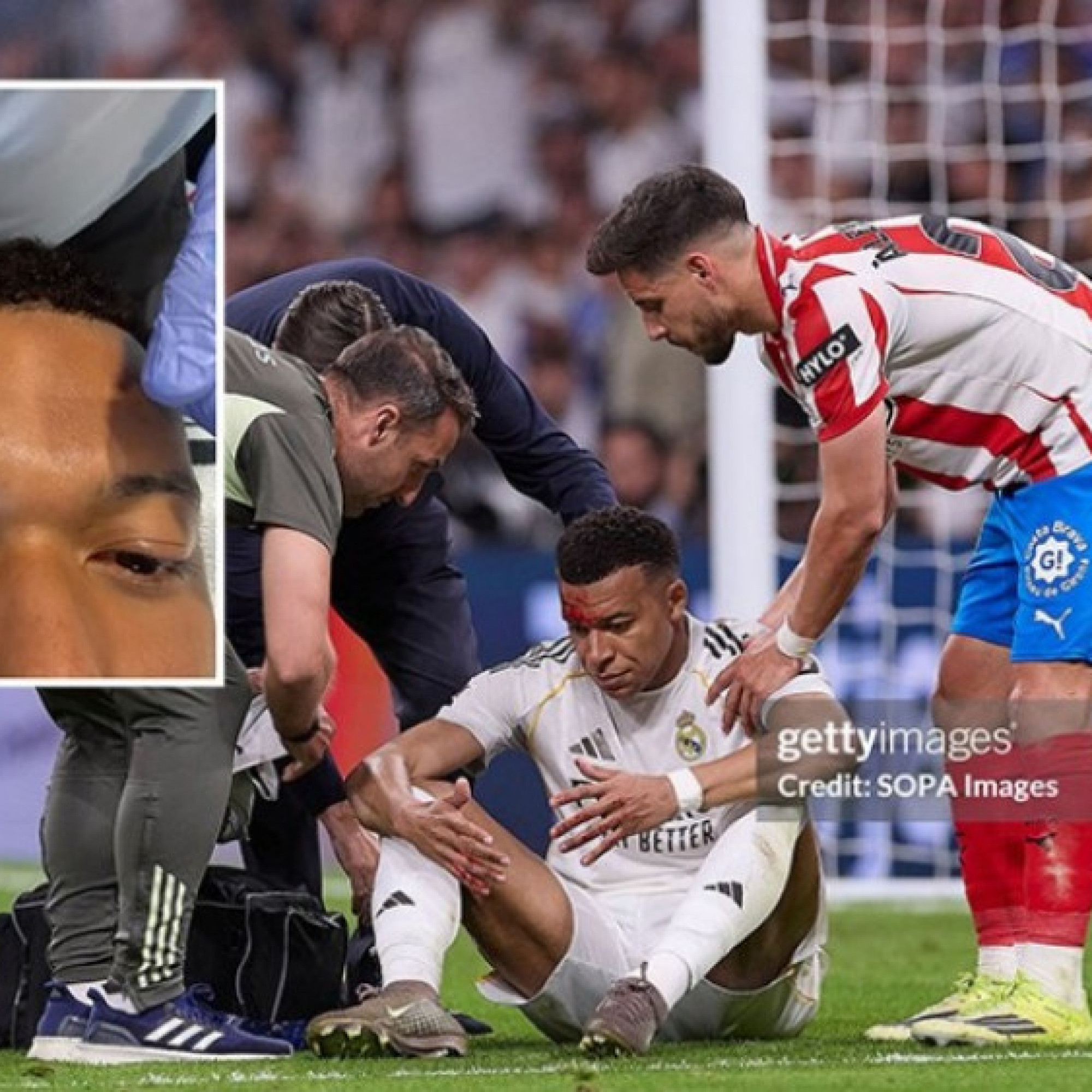  - Mbappe khâu 3 mũi, vắng mặt buổi tập của Real: Có lỡ đại chiến Bayern?