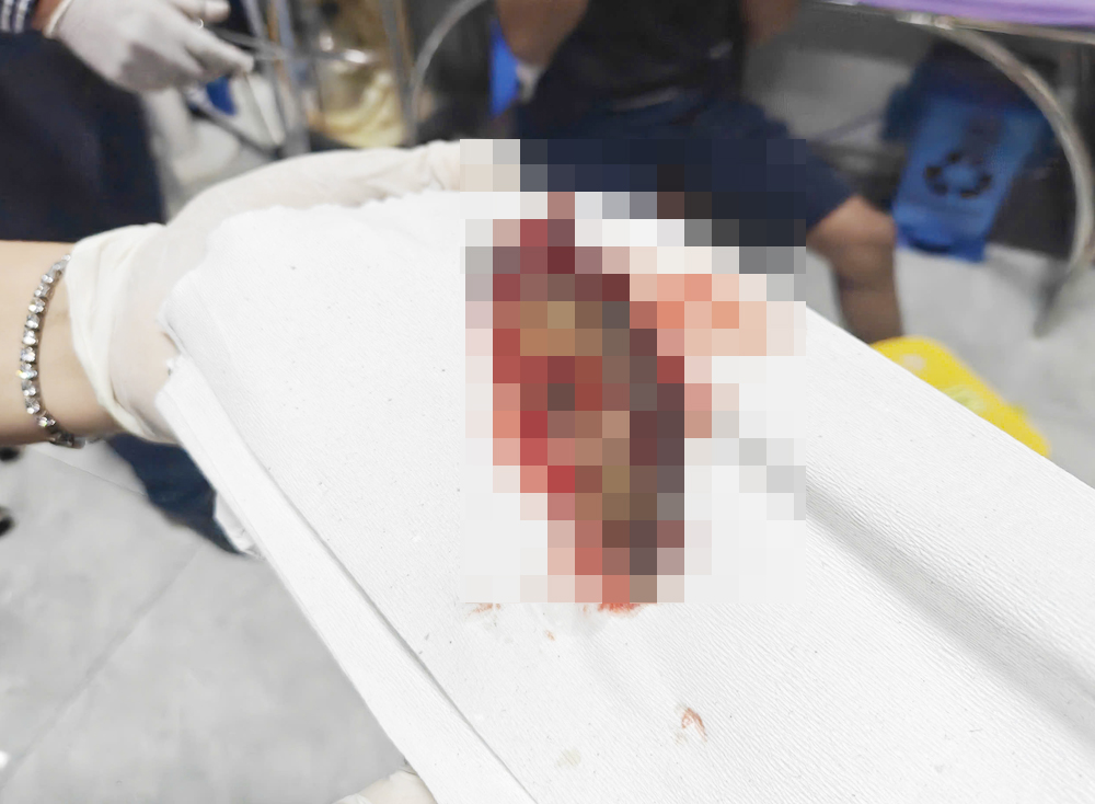 Bác sĩ gắp con cá rô còn sống trong thực quản người đàn ông quê Cà Mau - 2