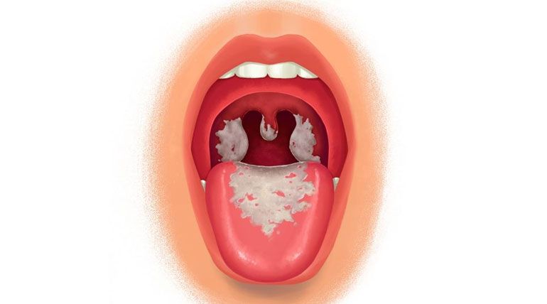 Triệu chứng dễ nhận biết của bệnh bạch hầu - 1