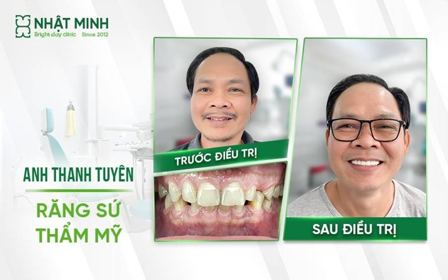 Nha khoa Nhật Minh - Hệ thống nha khoa 5 sao được hàng chục nghìn khách hàng tin tưởng - 2