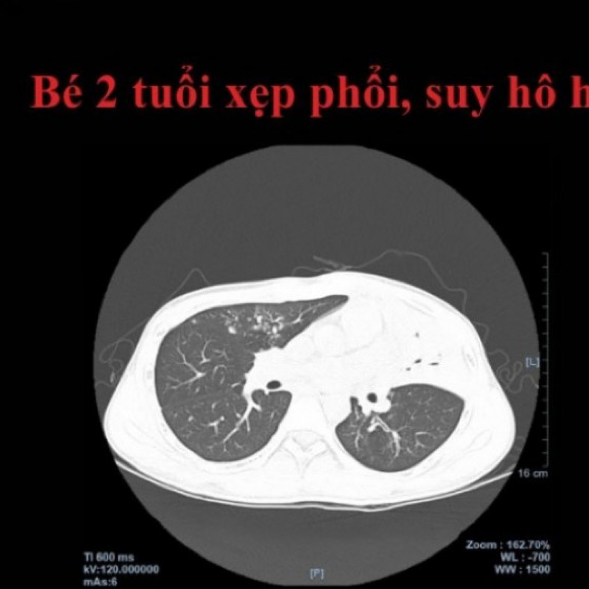 Giải trí - CT 2560 lát cắt: 1 giây phát hiện suy hô hấp giúp bé 2 tuổi thoát khỏi nguy kịch