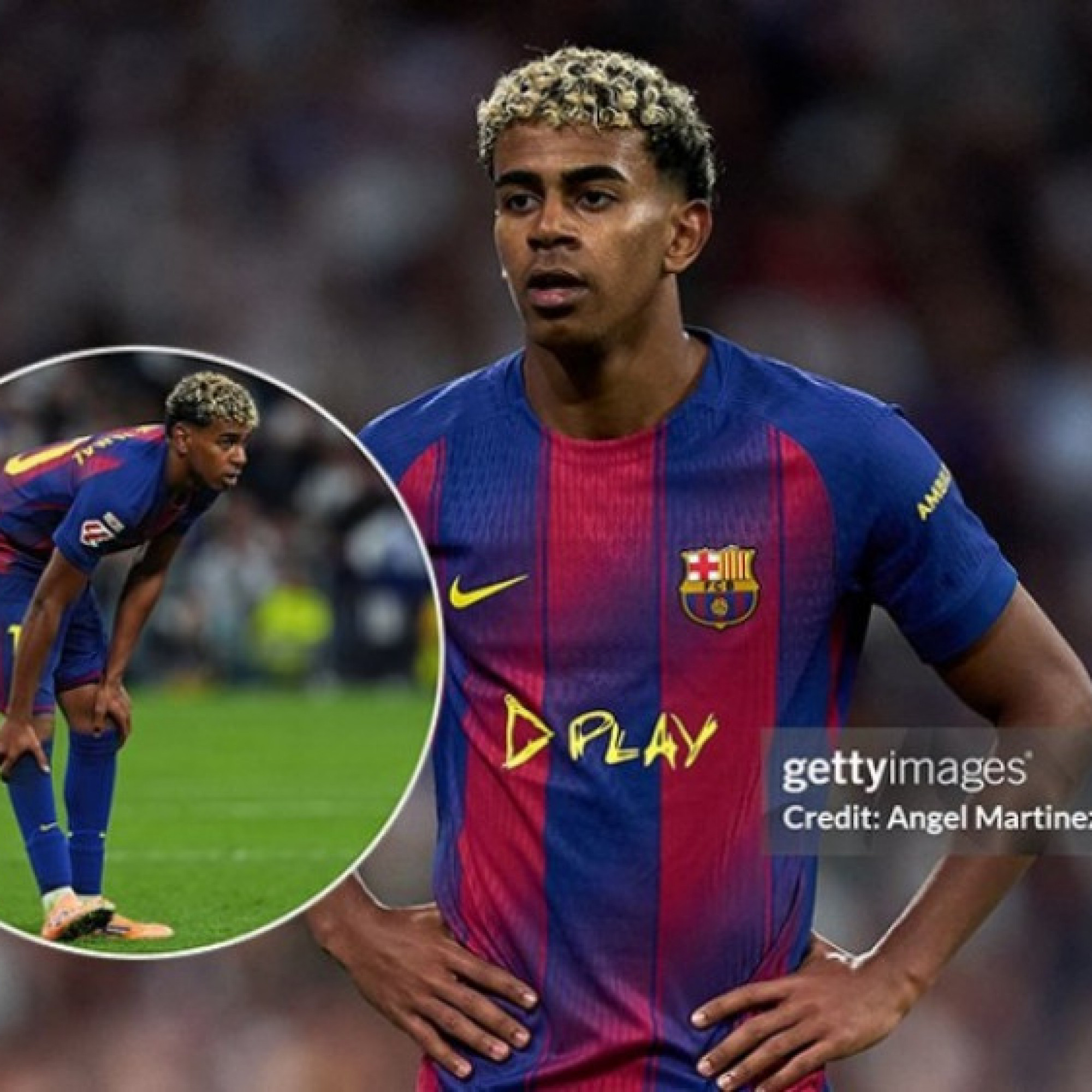  - Bác sĩ tiết lộ tình trạng chấn thương của Yamal, Barcelona lo lắng