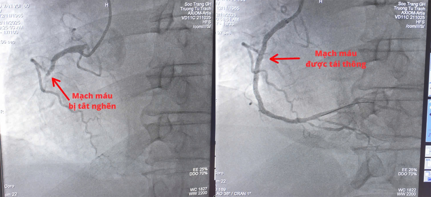 Bệnh viện Sóc Trăng cứu sống bệnh nhân nguy kịch trên đường chuyển tuyến - 2